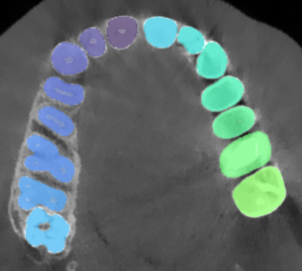 Axial dental CBCT slice with every tooth, pulp, the mandible and maxilla, nerve canals, sinuses and airway segmented into distinct colours.